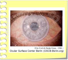 Fakten Uber Das Trockene Auge Ocular Surface Center Berlin
