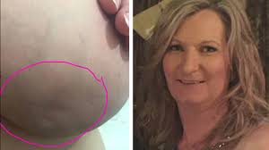 Also known as peau d'orange, dimpling of the breast causes the skin to look like the. Woman S Breast Cancer Warning Sign Photo Goes Viral Abc7 New York
