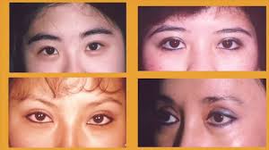Patients with sleepy eyes have a condition called . Eyelid And Brow Lift Victor Liu Md