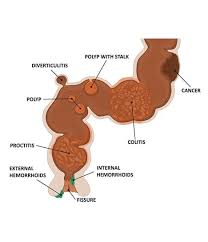 Image result for Blood in stool