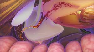 The pancreas is a long, flat gland that sits tucked behind the stomach in the upper abdomen. Acute Pancreatitis Digestive Disorders Merck Manuals Consumer Version