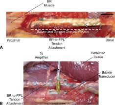 The thumb only receives the flexor pollicis longus (fpl). Mechanical Feasibility Of Immediate Mobilization Of The Brachioradialis Muscle After Tendon Transfer Journal Of Hand Surgery