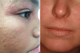 Image result for ekzema face