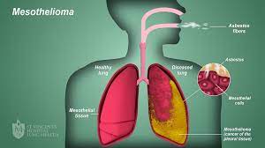 Exposure to asbestos fibres or asbestos dust is the main cause of mesothelioma, but in some cases there is no clear link to . Mesothelioma St Vincent S Lung Health