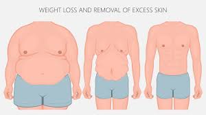 Although this is only a recommendation, it's one held closely by many plastic surgeons, and has even been translated into law in some states. Tummy Tuck And Liposuction Are They Weight Loss Procedures Houston Texas Dr Christopher Patronella