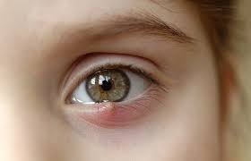 Ein gerstenkorn entwickelt sich rasch, ein hagelkorn langsam über einen längeren zeitraum; Gerstenkorn Am Auge Hordeolum Verlauf Behandlung Minimed At