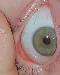 Kontaktlinse Nicht Zu Finden Im Auge Dringend Gesundheit Und Medizin Kontaktlinsen Verschwunden