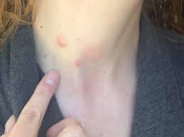Check spelling or type a new query. Coronavirus Long Haulers Are Developing Rashes A Sign Of Inflammation