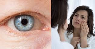 Maybe you would like to learn more about one of these? Ptosis Causes 8 Natural Treatments For A Drooping Eyelid Dr Axe