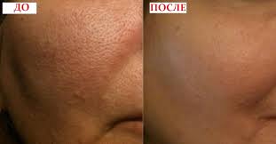 маска с желатином для лица от черных точек отзывы Idealnoe Lico Za 30 Dnej Skin Care Brands Skin Care Skin