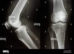 Image result for Knee XRay