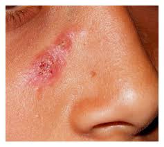 What is the natural habitat of sprothrix schenckii? Sporotrichosis An Overview And Therapeutic Options