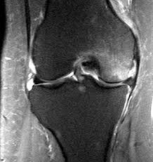 Located above the medial condyle, it bears an elevation, the adductor tubercle, which serves for the attachment of the superficial part, or tendinous insertion. Subchondral Fractures Radsource