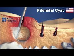Image result for Pilonidal Cyst