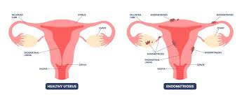 Endometriosis | The American Pregancy Association