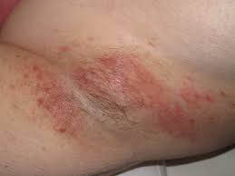 The causes of these bumps are many and varied. Common Rashes Found In The Armpits