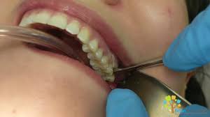 You have a small hook appear on the top corner incisors. Wisdom Tooth Extraction In Under 3 Minutes Youtube