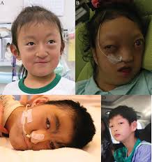 Natural histories of patients with Wolf‐Hirschhorn syndrome derived from  variable chromosomal abnormalities