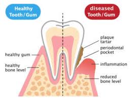 Image result for Periodontitis