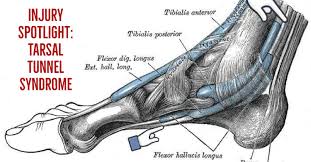 Injury Spotlight Tarsal Tunnel Syndrome Richard Lebert Registered Massage Therapy