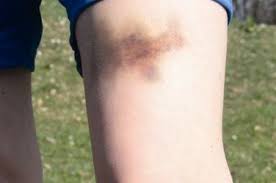 Schmerzhafter Pferdekuss Wie Werden Prellungen Behandelt Klinik Via Medici