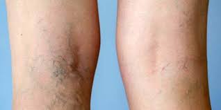 Apple cider vinegar for varicose veins. Natural Remedies For Varicose Veins Prevention