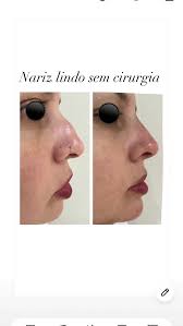 VOCÊ SABIA QUE CONSEGUIMOS TE DEIXAR COM UM NARIZ LINDO SEM CIRIRGIA?,  Resultado seguro e imediato , #dermatologia #dracarolineperillo  #rinomodelacao #nariz