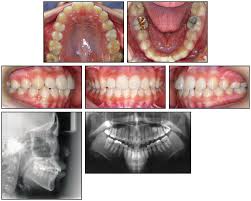 5.3.1 open exposure 5.3.2 closed eruption technique 5.3.3 open versus closed eruption techniques. Case Report Jco Online Journal Of Clinical Orthodontics