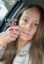 Lip Flip Journey: Day 1 Experience with Botox