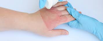 Doctors evaluate burns by degree. 4 Degrees Of Burns The Hand Society