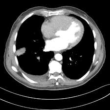 Imaging studies are helpful in evaluating patients who have symptoms suggestive of peritoneal carcinomatosis. Primary Peritoneal Epithelioid Mesothelioma Radiology Case Radiopaedia Org