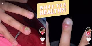 Biting the skin around fingernails can manifest itself in a repetitive manner or as an occasional thing. Girl S Nail Biting Infection Nearly Leads To Fingertip Amputation Health Com