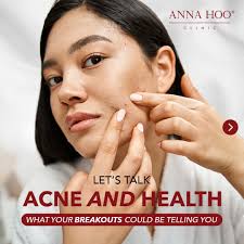 🤔 Did you know your acne could be more than just a skin issue? Different  breakout zones