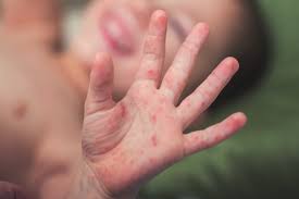 How to stop the itchy blisters on hands? Rashes In Children Learning Article Pharmaceutical Journal