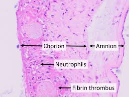 Image result for Chorioamnionitis