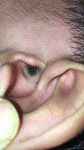 Kutu telinga makan cairan pada kanal telinga, dan biasanya menyerang kanal telinga vertikal dan horizontal. Seri Penawar Pernah Dengar Kutu Babi Di Utara Femes