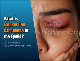 Merkel cell carcinoma (mcc) usually starts on areas of skin exposed to the sun, especially the face, neck, arms, and legs, but it can occur anywhere on the body. What Is Merkel Cell Carcinoma Of The Eyelid Merkel Cell Carcinoma Of Thigh