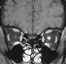 Optic Neuritis Radiology Reference Article Radiopaedia Org