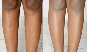 8 Ways To Get Rid Of Dark Spots On Legs Fast Dark Spots On Legs Spots On Legs Airbrush Legs