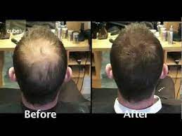 The first ten days are the most crucial days after your hair transplant. Mens Hair Loss Product Solution From Toppik Youtube