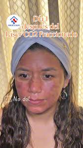 Tratamento de Olheiras com Laser CO2