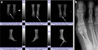 In fact, one of the primary reasons we get xrays following an ankle sprain is to check the base of the fifth metatarsal. Sesamoiditis Bone Scan Of The Bilateral Feet A In A Patient With Download Scientific Diagram