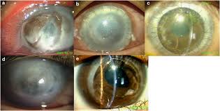 Image result for Gonococcal Conjunctivitis