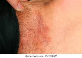 Image result for sore skin in the groin area