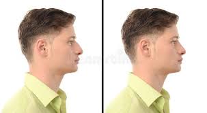 Before And After Photos Of A Young Man With Nose Job Plastic Surgery Man With R Ad Man Nose Photos Y Nose Job Rhinoplasty Nose Jobs Plastic Surgery