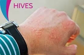 Image result for Hives