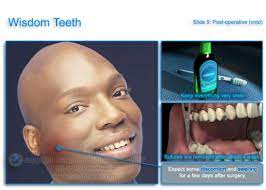 Helping your child through wisdom teeth removal can be a difficult and stressful task. Swelling After Wisdom Teeth Removal Teethwalls