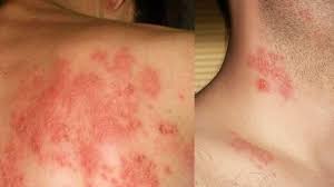 Herbal Obat Cacar Api Tradisional Yang Ampuh Dan Murah