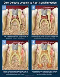 Steps Gum Disease Leading To Root Canal Infection Image Credit Dear Doctor Inc Gum Inflammation Gum Disease Root Canal