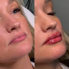 Hannah Kinard, RN BSN ✨ Aesthetic Nurse (@aestheticskin_rn) • Instagram  photos and videos